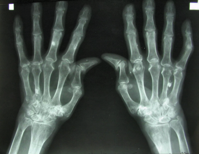3D printed living tissues could spell the end of arthritis Horizon Magazine Blog