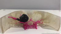 Medical innovators use 3D modeling to remove brain tumor KSL com